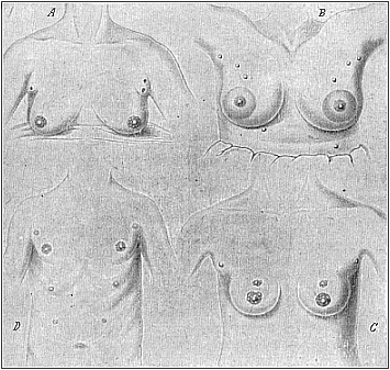 Fig.103, A, B. C, D. Instances of redundant mammary glands and nipples (hypermastism).